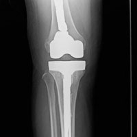 Marc Thompson wrote, "Here's what ended up being put in my right knee the following February after getting a bone eating virus and 12 weeks of antibiotics once every 8 hours. I'm pretty much all better now almost 10 years later but that 9 month ordeal was SCARY!"